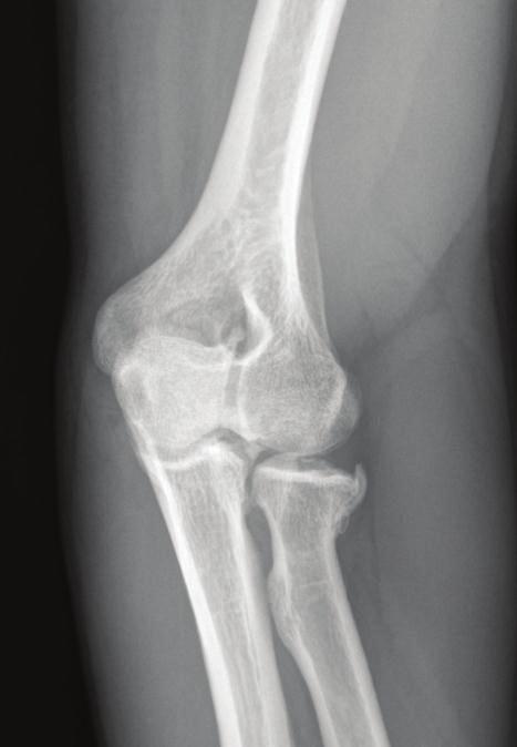 Radiographs demonstrate anterolateral osteophytes noted at the radial head and decreased joint space in the radiocapitellar joint.