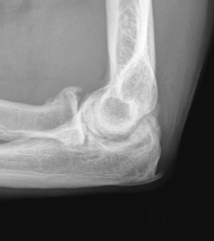Conversely, malunion of distal humerus or olecranon fractures which extend intraarticularly into the ulnohumeral joint typically result in arthritis which is symptomatic during flexion and extension.