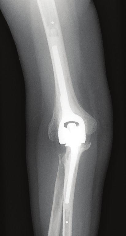 Arthritis 5 of comminuted radial head fracture, it is not effective in the setting of radiocapitellar arthritis since the capitellum has already degenerated.