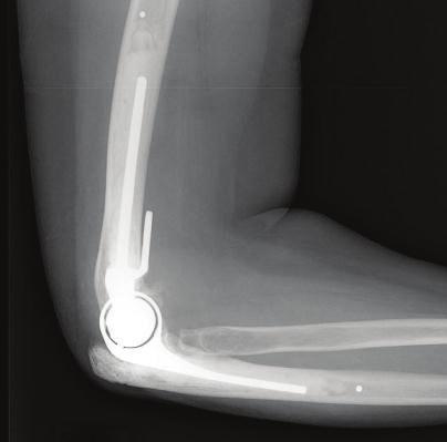 Innovations in implant design and surgical technique continue to evolve and outcomes are being more widely reported as surgical experience with these implants expands for use in treating