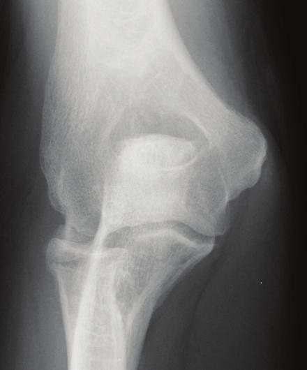 Figure 5: A young male laborer with symptomatic arthrosis of the radiocapitellar joint (A) underwent radial head resection; follow-up radiographs demonstrate progressive ulnohumeral arthritis