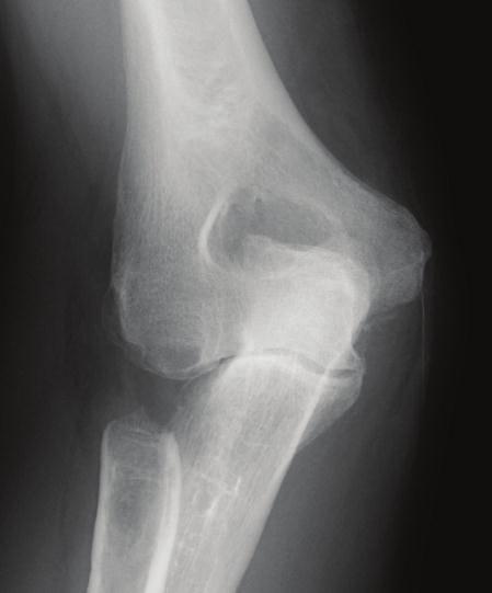 Lateral elbow pain localized to the radiocapitellar joint with forearm rotation helps the practitioner identify patients with symptomatic arthritis of the radiocapitellar joint, and several authors