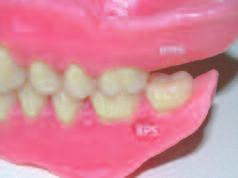 BPS CORE PRODUCTS 1 Ivoclar Vivadent teeth Matching the wide variety of shapes observed in natural teeth is the challenge that the wide