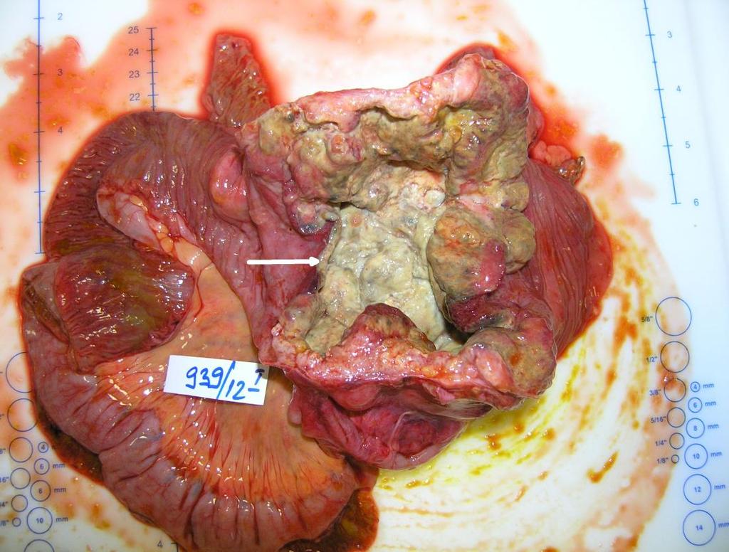 Picture 3 Giant yellowish white neuroendocrine carcinoma in the caecum (arrow) Slika 3.