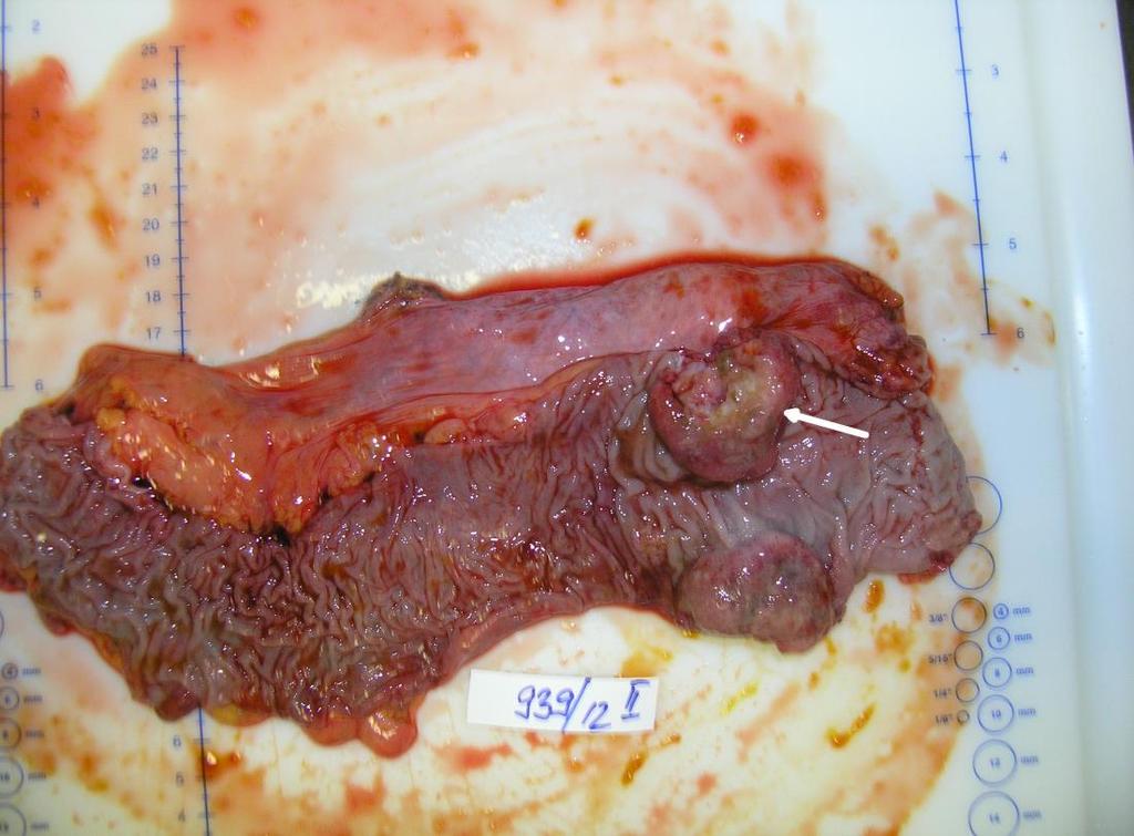 Picture 5 Macroscopic appearance of the resected specimen. Exophytic adenocarcinoma in the rectum (arrow). Slika 5. Makroskopski prikaz reseciranog uzorka.