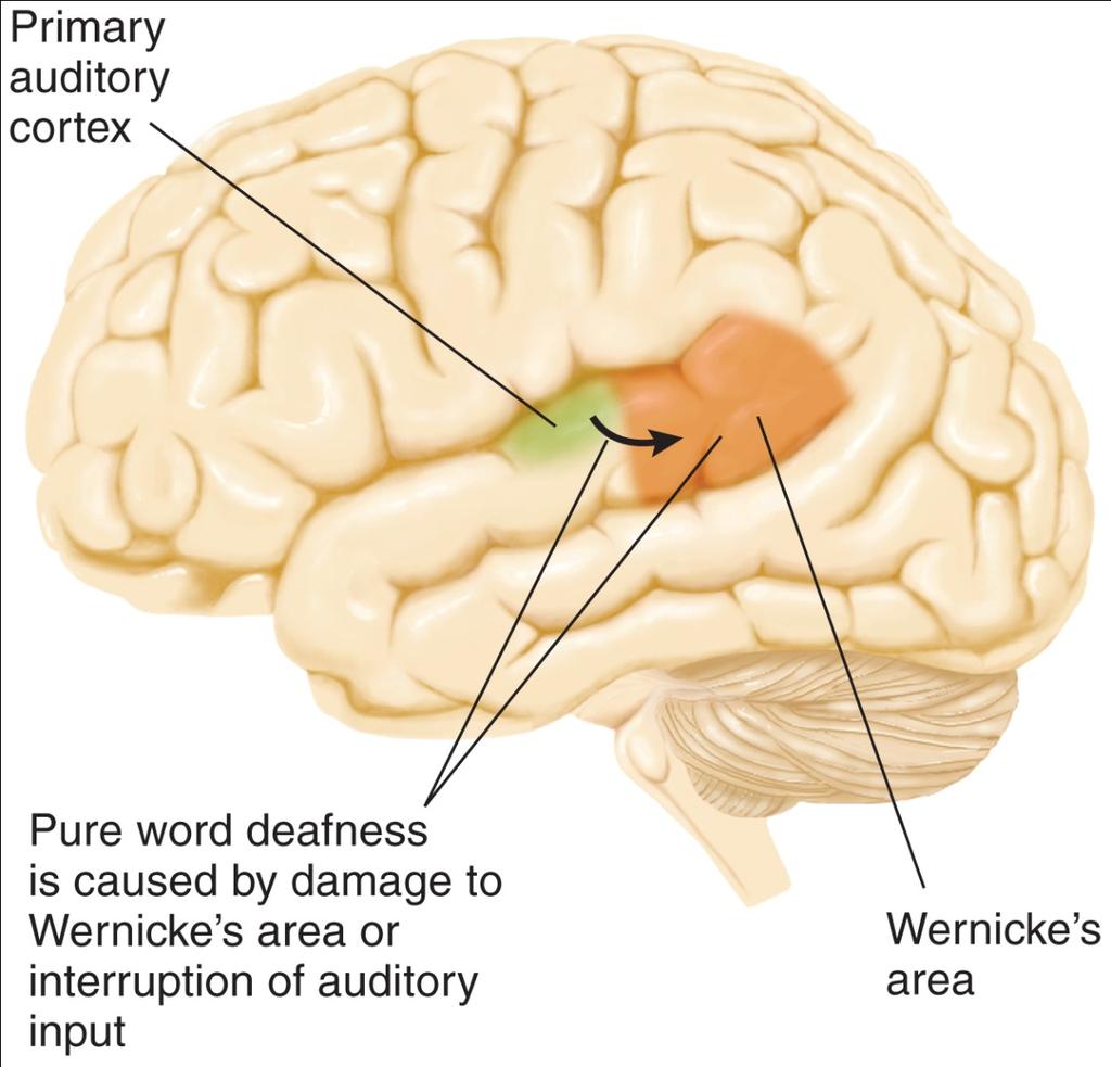 n Wernicke s area is also implicated in Pure Word Deafness n Uncompromised recognition of nonspeech sounds and intonation.