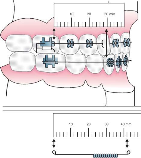3 MATERIALS AND METHODS Six cases of skeletal Class II malocclusion with retrognathic mandible were selected. All the patients were in the age group of 11 and 16 years including both male and female.