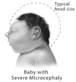 urinary retention may occur Microcephaly and other neuro conditions in