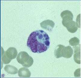 hemolytic anemia, renal failure Severity ranges from asymptomatic to lifethreatening Images from cdc.