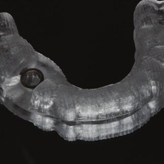fundamental implant concepts specific to 3D implant dentistry. Virtual Planning Learn a proven step by step, systematic approach to ideal virtual implant planning.