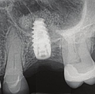 This course is right for you if: ç You want to expand the scope of your implant practice beyond simple cases Through extensive hands-on exercises