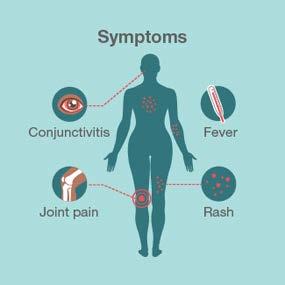 Symptoms of Zika Virus Infection Similar to other viral illnesses Fever Rash