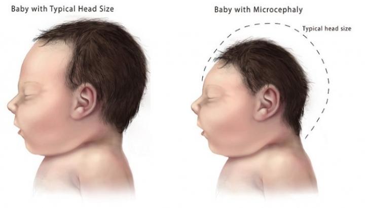 Zika Infection in Pregnant Women A. Small head circumference. B. Collapse of the fetal skull follows fetal brain destruction.