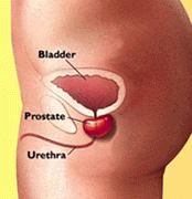 Why do I need a transrectal prostate ultrasound scan?
