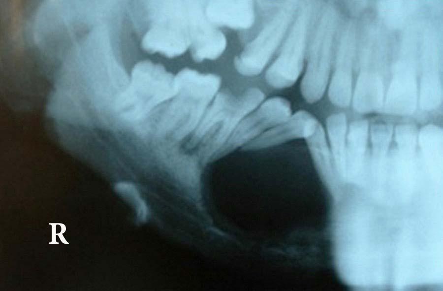 right canine and premolars.