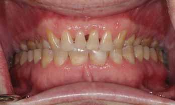 Introduction When multiple teeth or localised segments of the mouth require crowns, the restorative interventions involved can be psychologically and physically demanding for the operator, patient