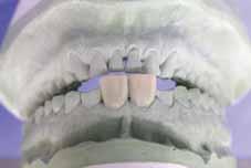 the anterior determinants of the occlusion have been re-established in the diagnostic wax-up.