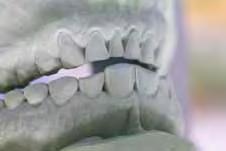 This is known as a feasibility study and can be used to inform the dentist of the restoration type