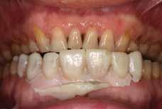 A B A C D B FIGURES 11a, 11b, 11c, 11d: The aforementioned diagnostic wax-up can be transferred to the mouth to make a diagnostic mock-up, to inform the dentist of the tooth preparations required,