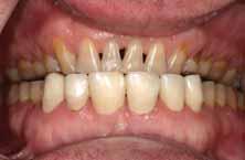 Transferring the diagnostic work to the mouth Using a putty matrix, the diagnostic wax-up may be transferred to the mouth using a bis-acryl material, such as Protemp, prior to any invasive operative