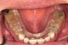 This technique is known as a diagnostic mock-up and it permits a meeting of the minds between the dentist s esoteric understanding of the treatment plan and the lay understanding that the patient may