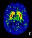 Imaging synaptic dopaminergic neurotransmission in vivo