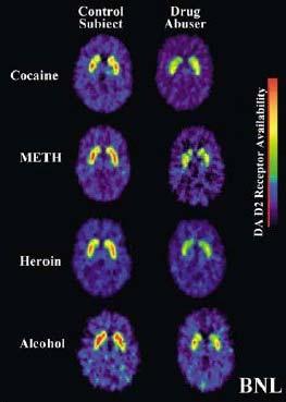 Dopamine Down Regulation Chronic exposure and dependence