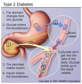 Most common type of diabetes People with type 2 diabetes do not make enough