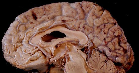 The anterior cerebral artery(aca): Runs medially & forwards in the longitudinal fissure along corpus callosum & ends by passing upwards near the
