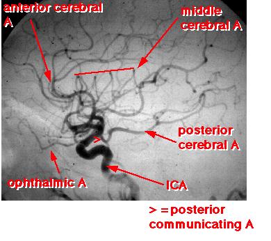 Upon exiting the cavernous sinus, the ICA extends through the meninges to become the supraclinoid segment The supraclinoid or cerebral ICA bends posteriorly and laterally between the oculomotor (III)