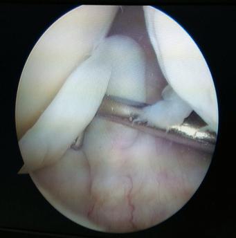 Fracture noted at intercondylar notch with subchondral cyst.