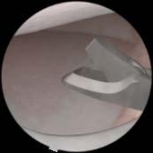 medial meniscus Remove damaged parts of the meniscus and smooth the borders with