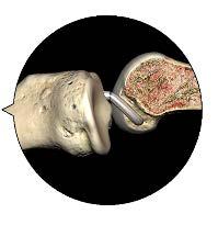 reconstruction Understand the mechanism of injury Anatomical concepts