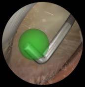 glenohumeral Locate virtual spheres in the glenohumeral joint Touch all the spheres