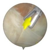 Locate the virtual stars in the glenohumeral joint Use the grasper to remove