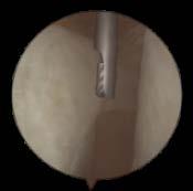 Subacromial decompression I Locate the hook on the
