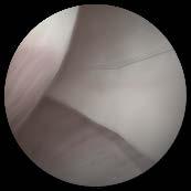 Locate the virtual stars in the glenohumeral joint  