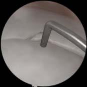 Diagnostic I Healthy right knee Menisci can be palpated