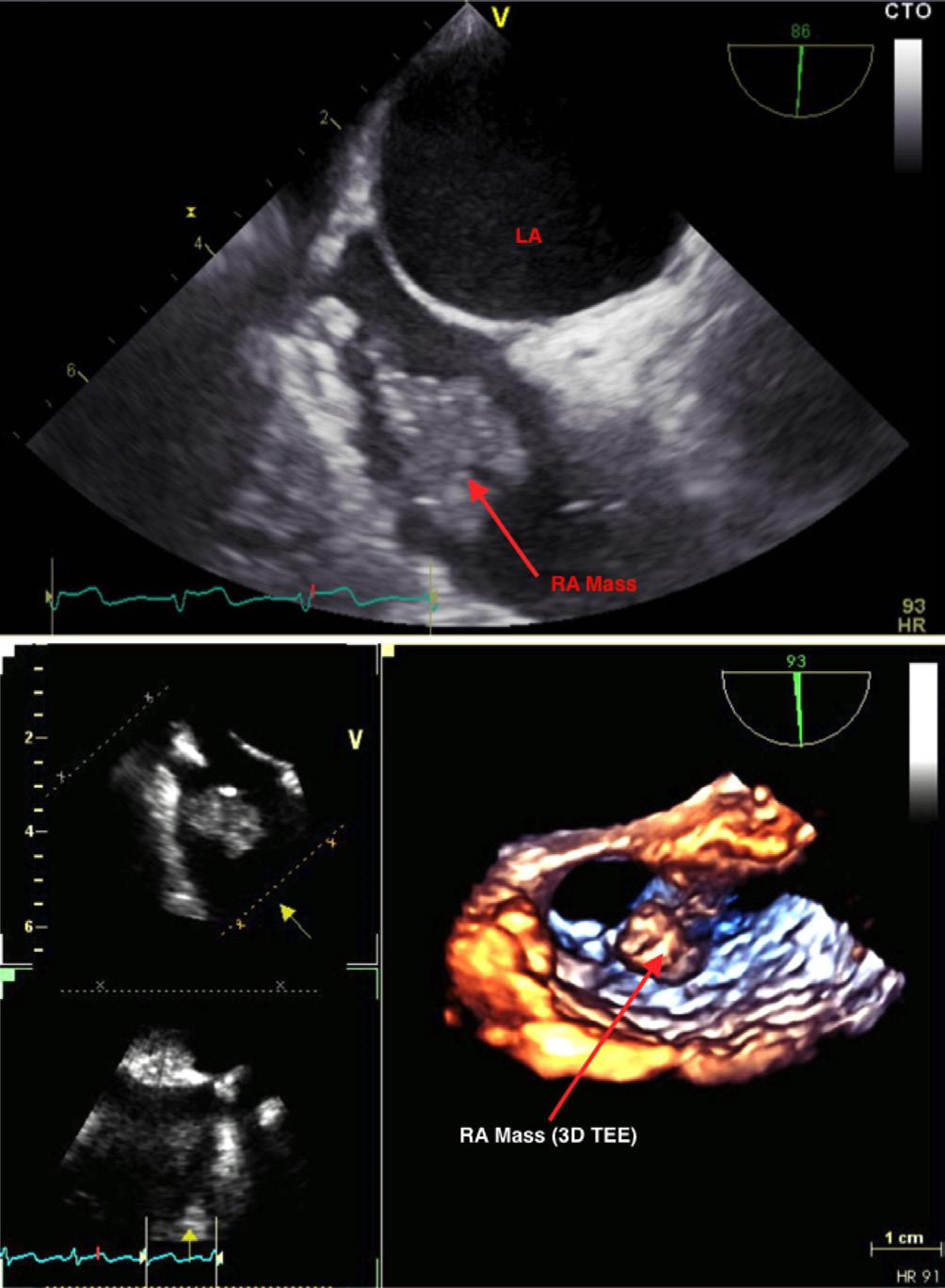 332 Enezate et al. Non-surgical extraction of right atrial mass Figure 1 Right atrial mass detection. () Two dimensional TEE showing the mass in R; () 3D TEE of the mass in R.