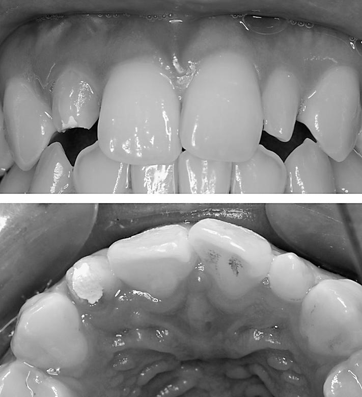 104 Kato H characterized by infolding of the enamel and dentin, sometimes as far as the root apex, but there is no immediate communication with the pulp.