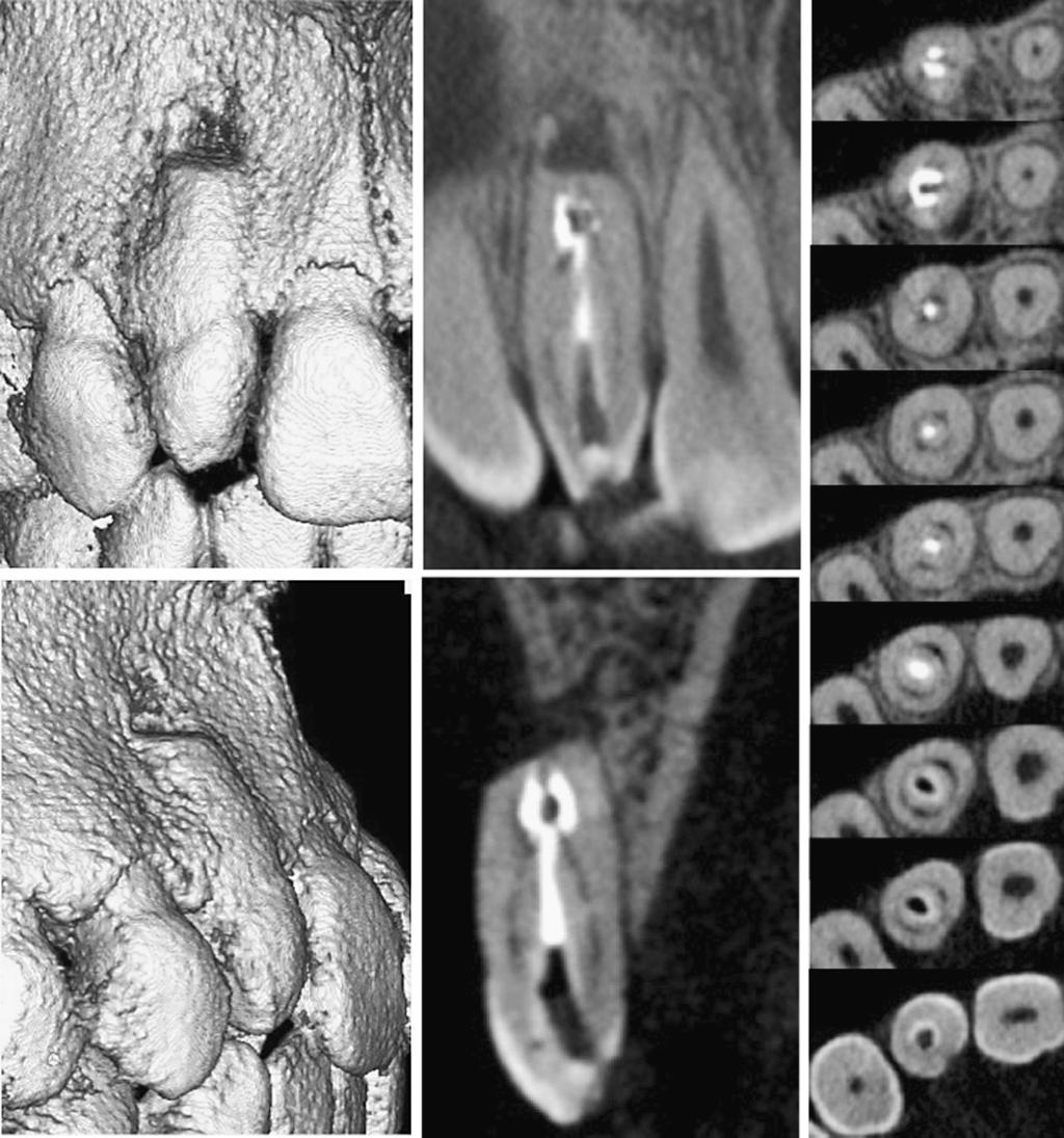 Treatment of Dens Invaginatus Type III 105 and CBCT images, of this patient for this case report. The tooth appeared as a peg-shaped microdont from the buccal view (Fig. 1).