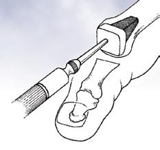 Flexible Great Toe (FGT) Step 3 Joint Preparation 3-1 3-2 A pilot hole is then made in the medullary canal of the metatarsal. The trial sizers are used to chose the correct size implant.