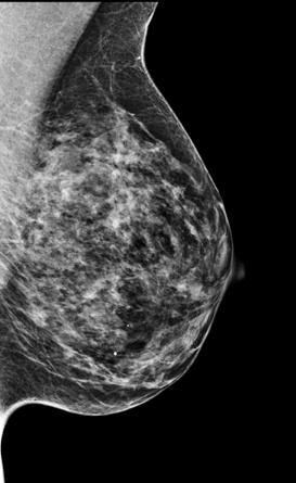 Not all 3D mammography systems are the same Image quality is key to early detection, which is why we continue to push our breast imaging technology forward, and the Selenia Dimensions 3D system is no