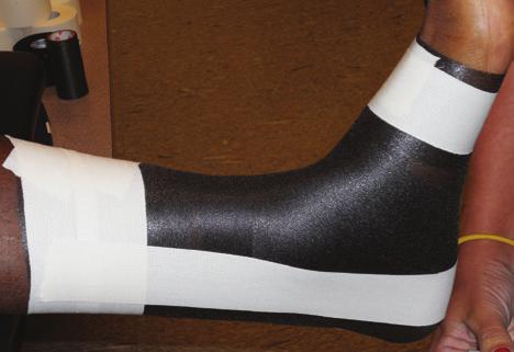 Ankle Taping Be sure circulation to taped extremity is checked before and after tape is applied. 5. Apply a stirrup.