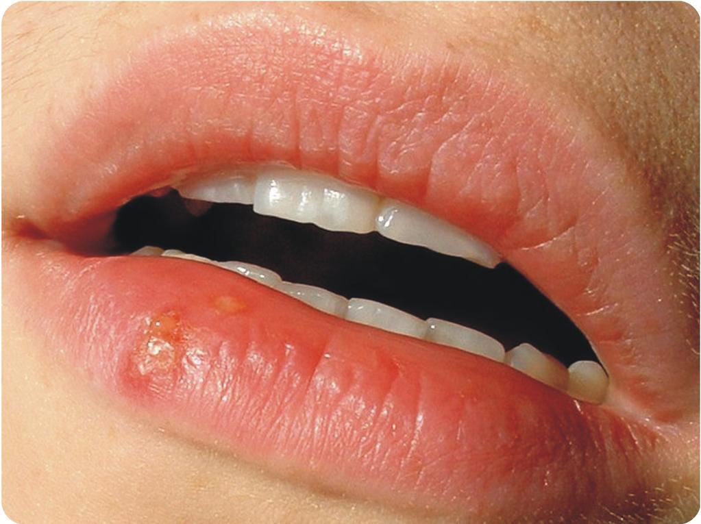 Cold Sore: Cold sores are caused by a herpes virus. Some viruses live in a dormant state inside the body. This is called latency.