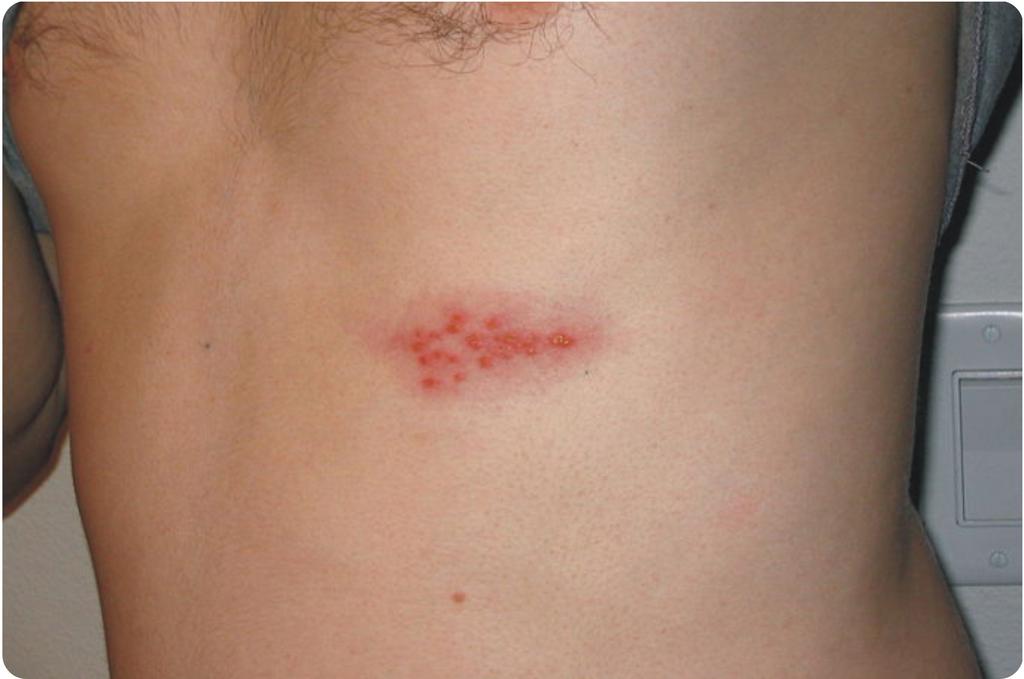 Shingles: Shingles is a disease caused by the same virus that causes chicken pox. Some viruses can cause cancer. For example, human papillomavirus (HPV) causes cancer of the cervix in females.