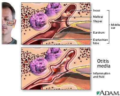 Infections and Otitis Media Pathogenic organisms can gain entrance to the middle ear by ascending through the auditory tube from