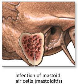 Complications of Otitis Media Acute mastoiditis Meningitis and a cerebral