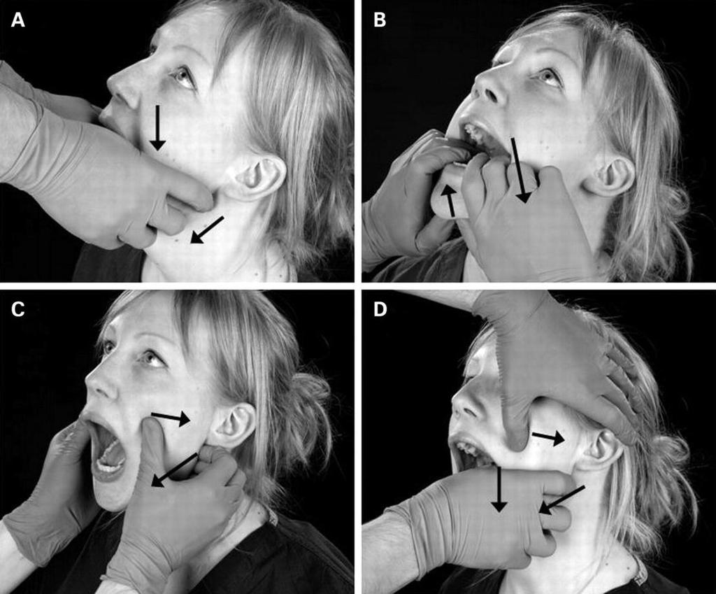 Dislocation of the Temporomandibular Joint Reduction of the dislocation is easily achieved by pressing the gloved thumbs downward on the lower molar teeth and pushing the