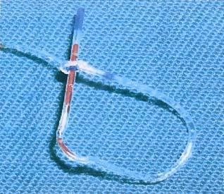 SURGICAL REMOVAL OF A LOOPED AND KNOTTED EPIDURAL CATHETER IN A POSTPARTUM PATIENT 915 lactate was running. Patient was comfortable and stable all through her labour which lasted around 4 hours.